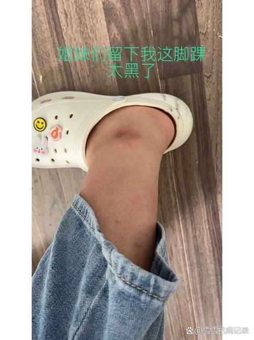 脚踝皮肤变黑是何原因?如何有效改善?