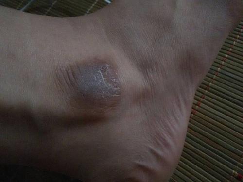 脚踝皮肤变黑是何原因?如何有效改善?