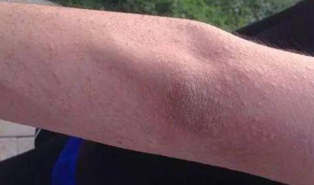 皮肤针扎感是何原因?