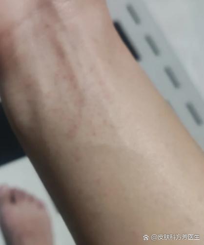 皮肤针扎感是何原因?