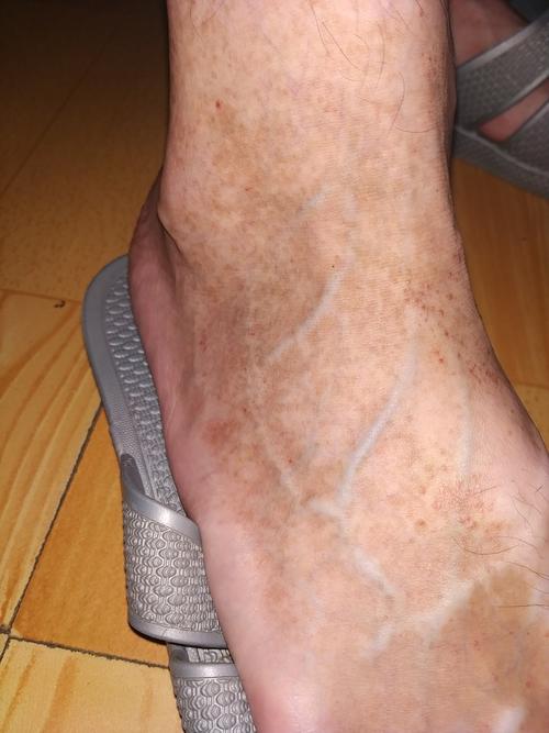 脚面皮肤发黑是何原因?