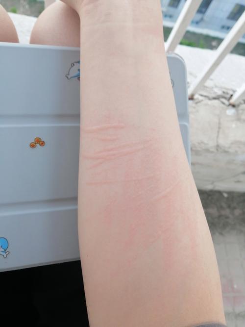 皮肤划痕性荨麻疹图片有何特征?