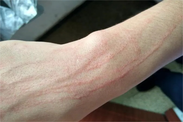 皮肤划痕性荨麻疹图片有何特征?