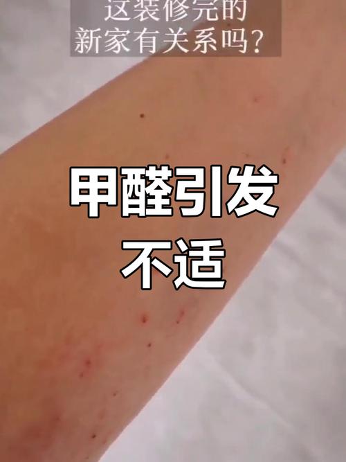 甲醛过敏,皮肤症状如何应对?