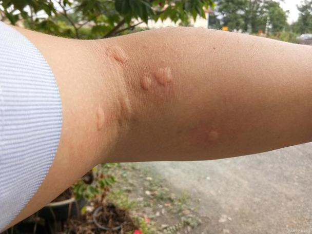 甲醛过敏,皮肤症状如何应对?