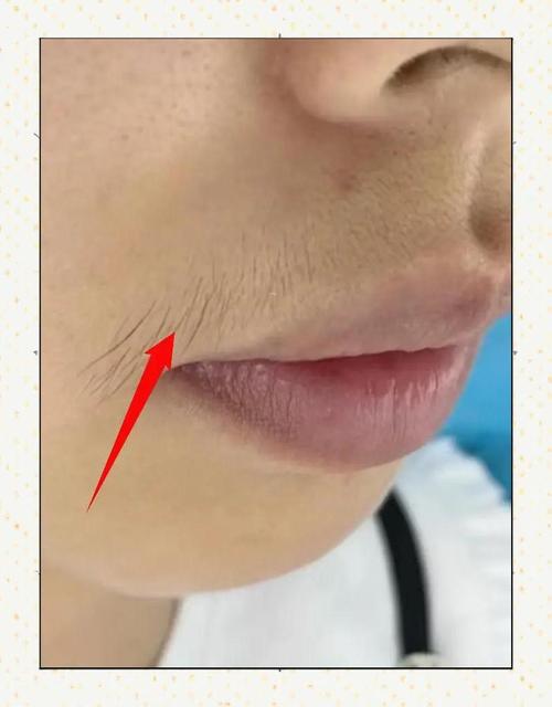 激光脱脸毛伤皮肤吗?