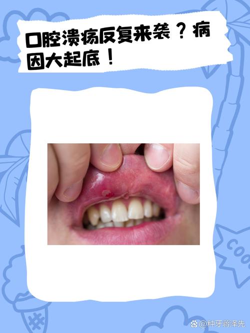 口腔溃疡接吻会传染疾病吗?