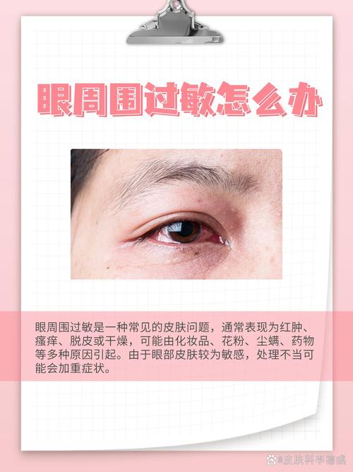皮肤过敏为何引发眼睛肿?