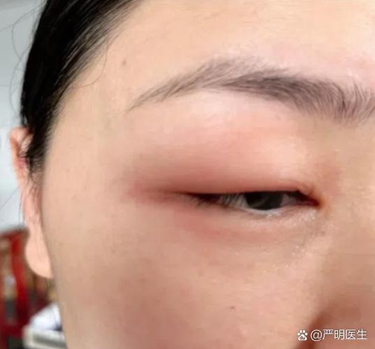 皮肤过敏为何引发眼睛肿?