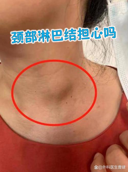 口腔淋巴结具体位置在哪里?