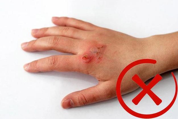 牙膏灼伤皮肤,应急处理该怎么做?