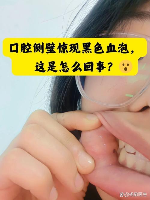 口腔溃疡中间黑点是恶化信号吗?