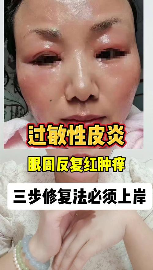 眼部红肿痒怎么快速缓解?