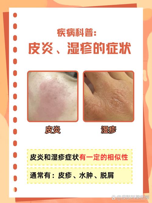 皮肤过敏和湿疹到底咋区分?