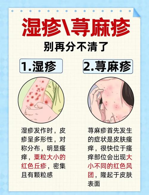 皮肤过敏和湿疹到底咋区分?