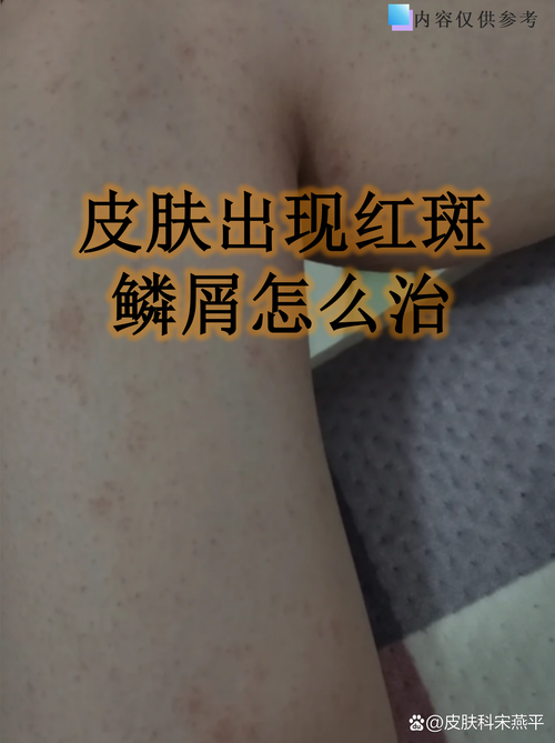 皮肤起红斑发痒,是过敏还是其他问题?