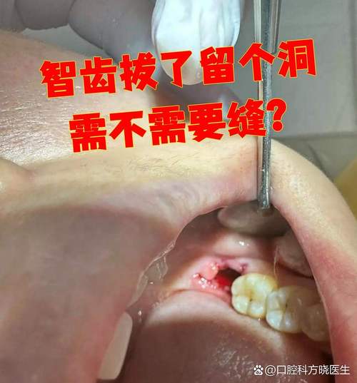 拔牙缝针为何会缝到口腔壁上?