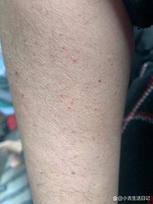 皮肤凸起小红点是过敏还是其他问题?
