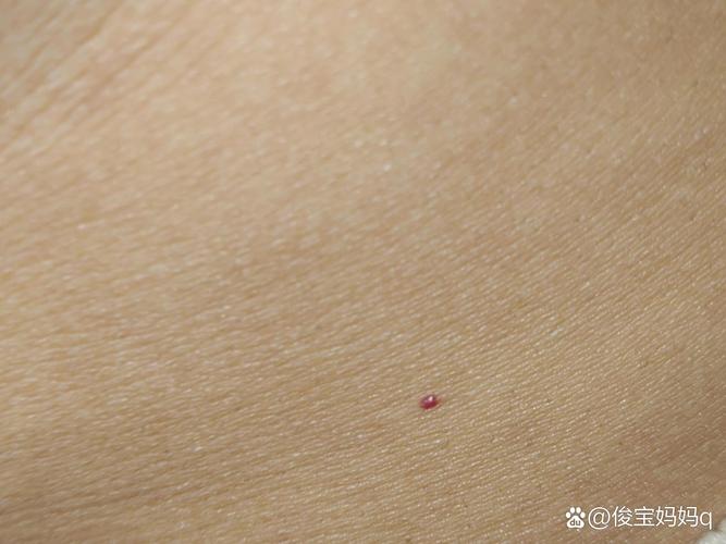 皮肤凸起小红点是过敏还是其他问题?