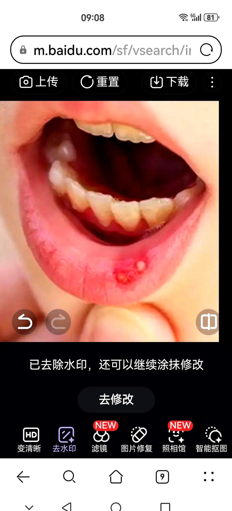 牙膏会导致口腔溃疡吗?