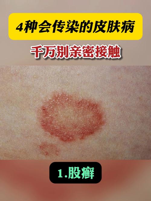 皮肤接触会传染哪些病?