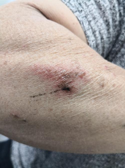 皮肤接触会传染哪些病?