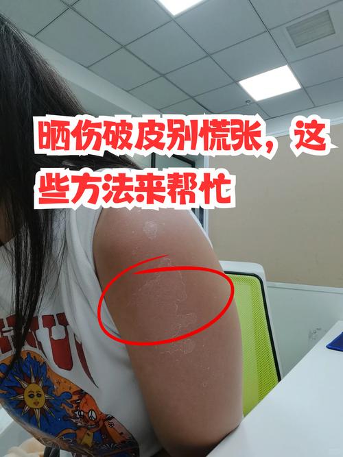 晒伤后皮肤多久能恢复?