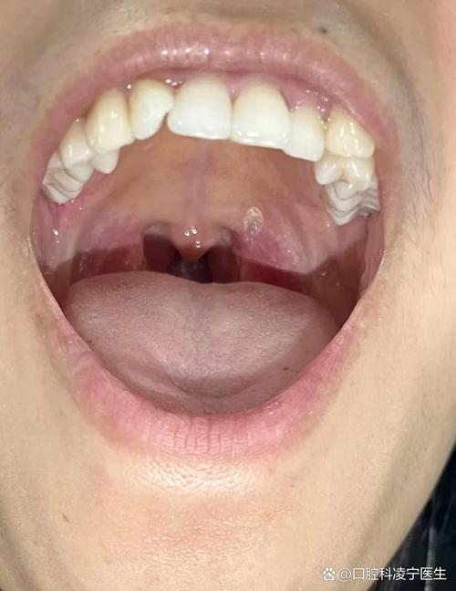 口腔旁长肉疙瘩是何问题?需警惕吗?