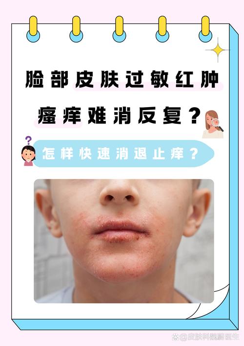 皮肤过敏不吃药,能自愈吗?