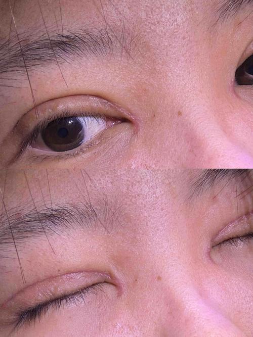 疤痕皮肤适合做双眼皮吗?