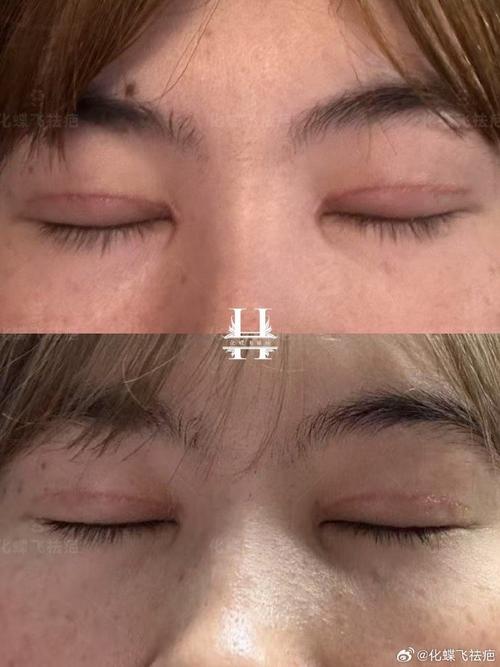 疤痕皮肤适合做双眼皮吗?