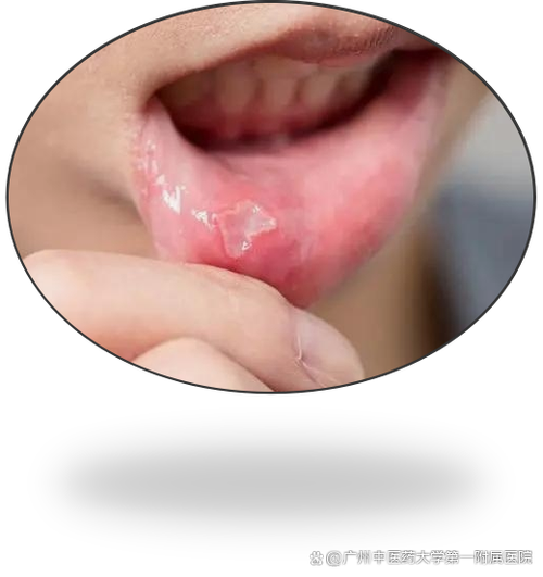 口腔黏膜破损疼不疼?