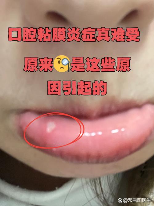 口腔黏膜破损疼不疼?