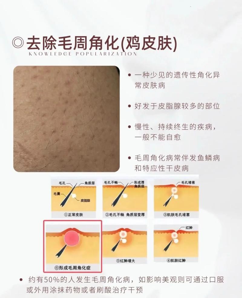腿上鸡皮肤怎么去除?30字疑问标题