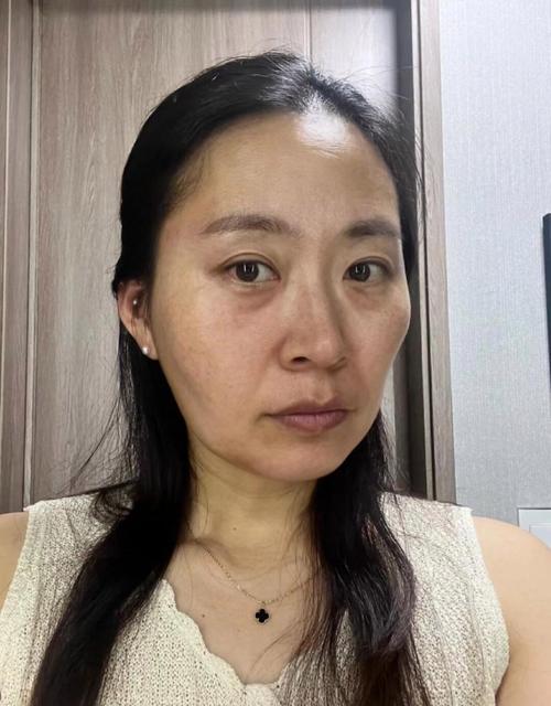 33岁皮肤松弛正常吗?