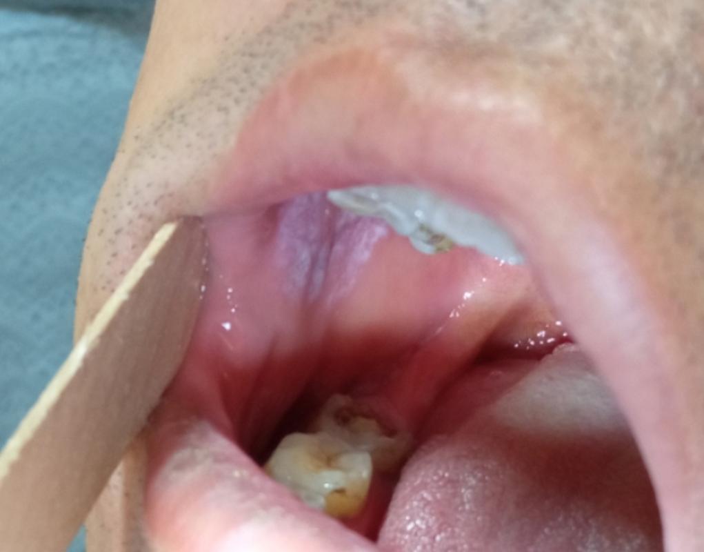 口腔白念球菌感染图片长啥样？