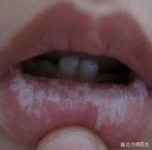 口腔白念球菌感染图片长啥样?