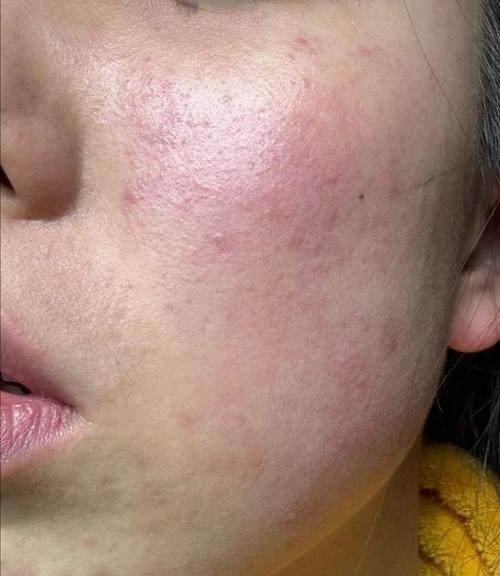 皮肤过敏红肿瘙痒图片怎么办？