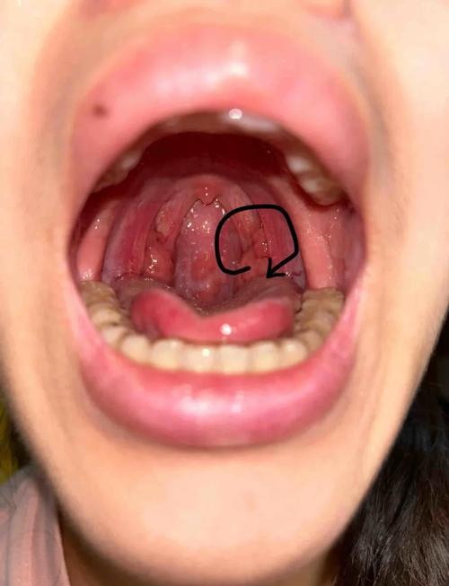 正常的口腔到喉咙图片有哪些健康特征？