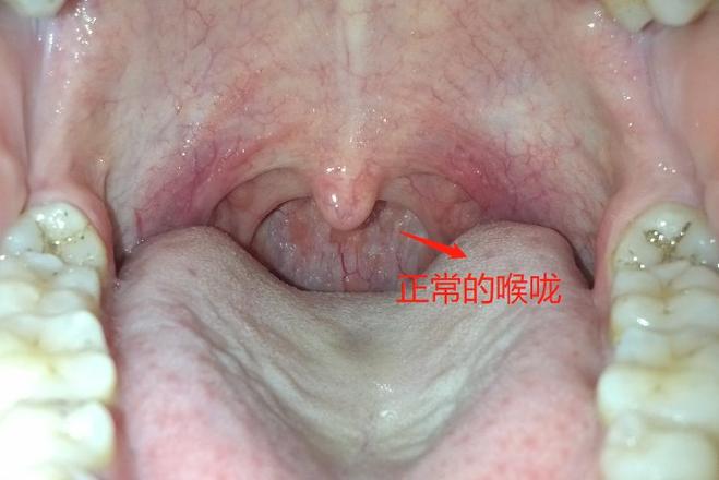 正常的口腔到喉咙图片有哪些健康特征?