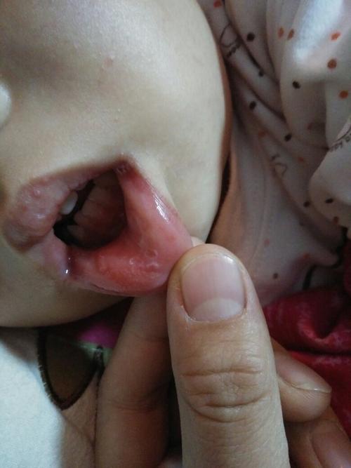 新生婴儿口腔溃疡图片能看出什么问题？