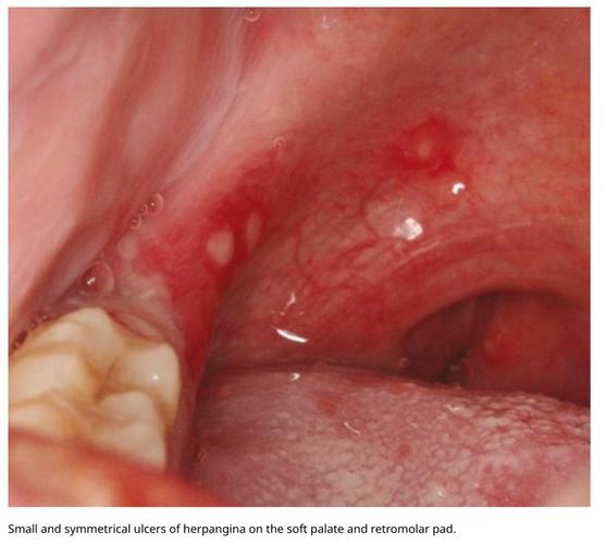 新生婴儿口腔溃疡图片能看出什么问题?