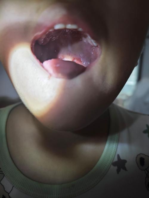 口腔疱疹发烧几天能好？