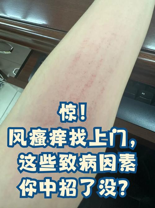 风湿病会引发皮肤瘙痒吗？