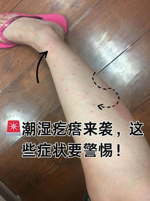 风湿病会引发皮肤瘙痒吗?