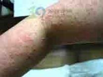 水银中毒皮肤症状图片有哪些特征？