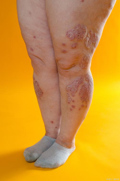 水银中毒皮肤症状图片有哪些特征?