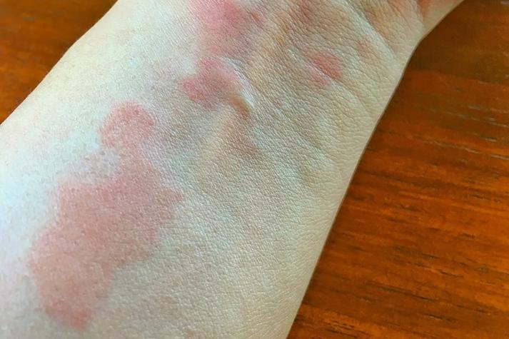 水银中毒皮肤症状图片有哪些特征?