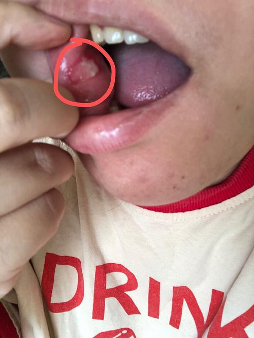 口腔反复溃疡长泡是何原因？