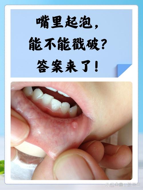 口腔上颚起水泡是何原因？